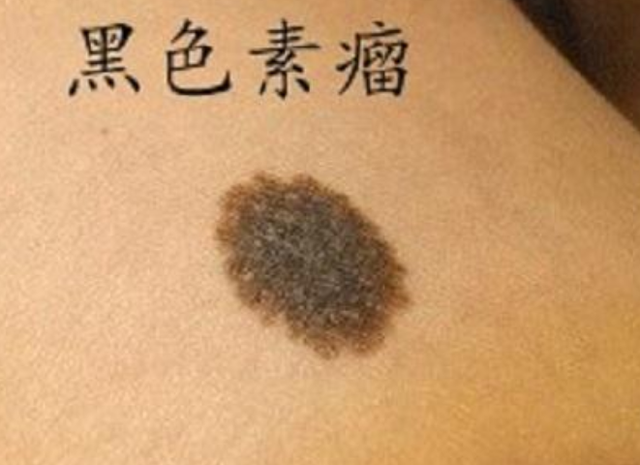 治疗黑色素瘤最好的办法就是早期诊断及早手术,否则预后差.