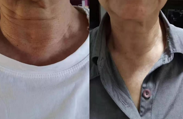 丝瓜可以保护甲状腺43岁男子天天吃现在甲状腺结节怎么样了