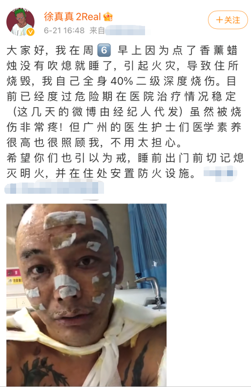 徐真真为什么会被烧伤前后对比照 徐真真怎么烧伤的原因介绍