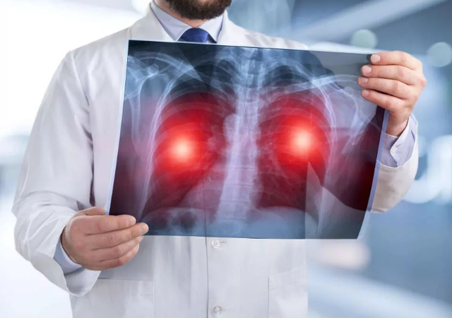 49岁大叔体检查出肺结节,以为是肺部炎症,两年后发展到肺病中期