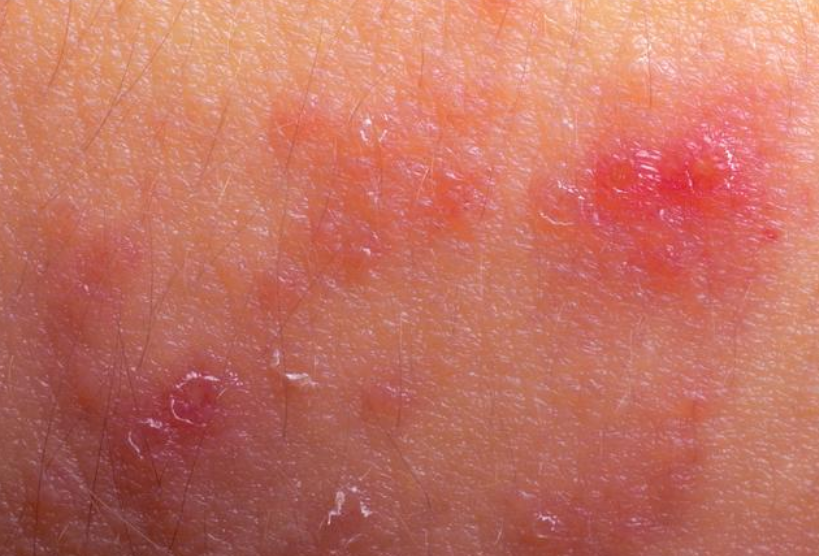 湿疹患者的"三大自律,六注意"|湿疹|皮疹|患者_新浪新闻