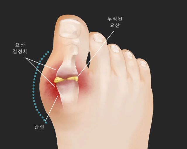 痛风就是其中一个,发生的时候,尤其是身体的那些关节的部位会有很明显