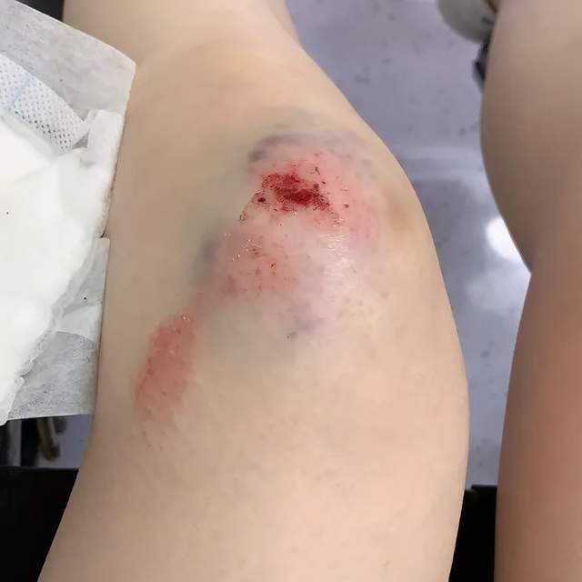见她的下巴和手脚都有不同程度的皮外伤,而膝盖处不但擦伤还撞瘀了