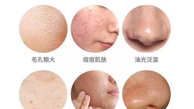 男性也有干性,中性,油性,混合性皮肤特质,应如何护肤(油性)