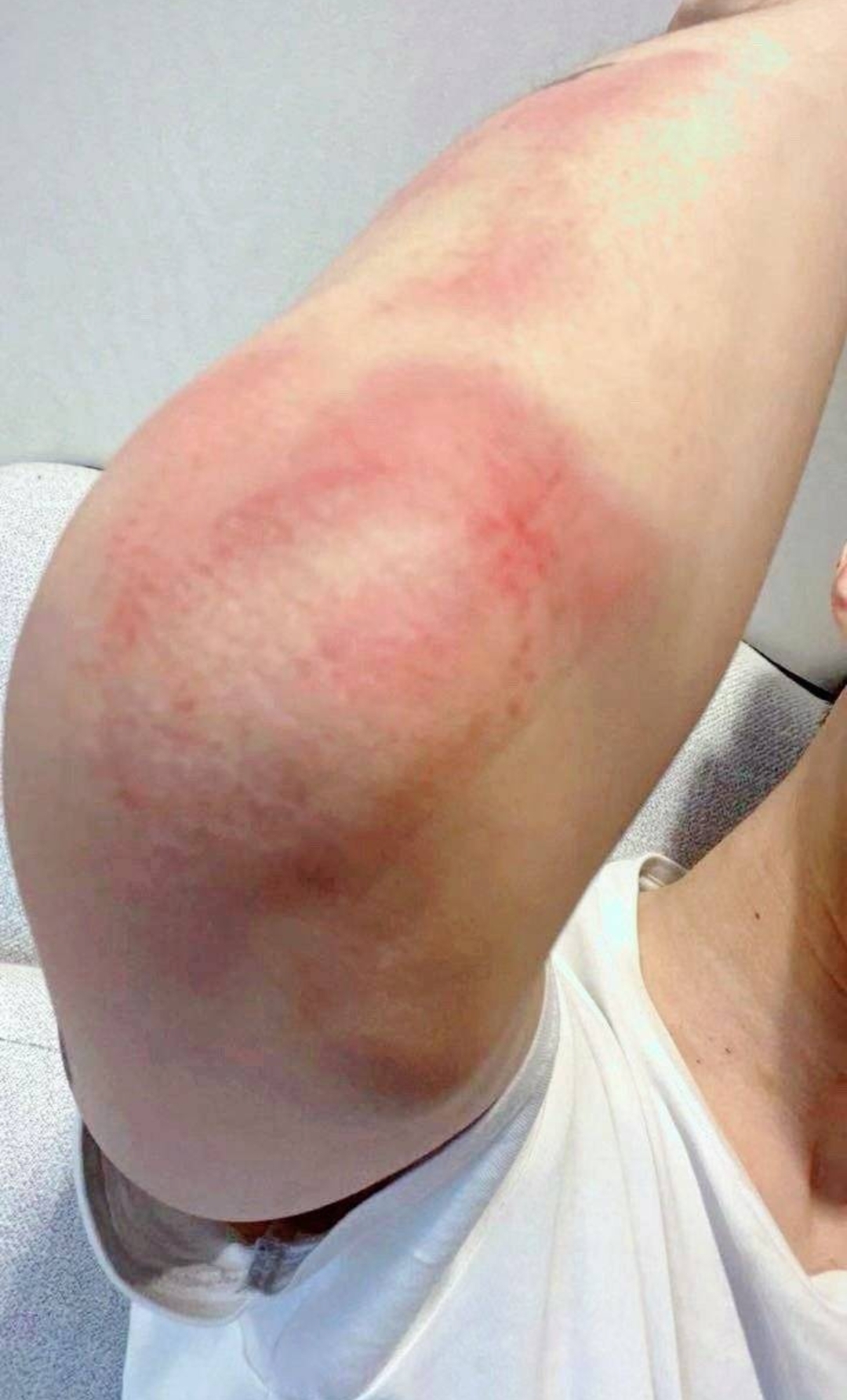 看网友晒出来的照片,是一张疑似范丞丞的胳膊红肿的特写,在关节处确实