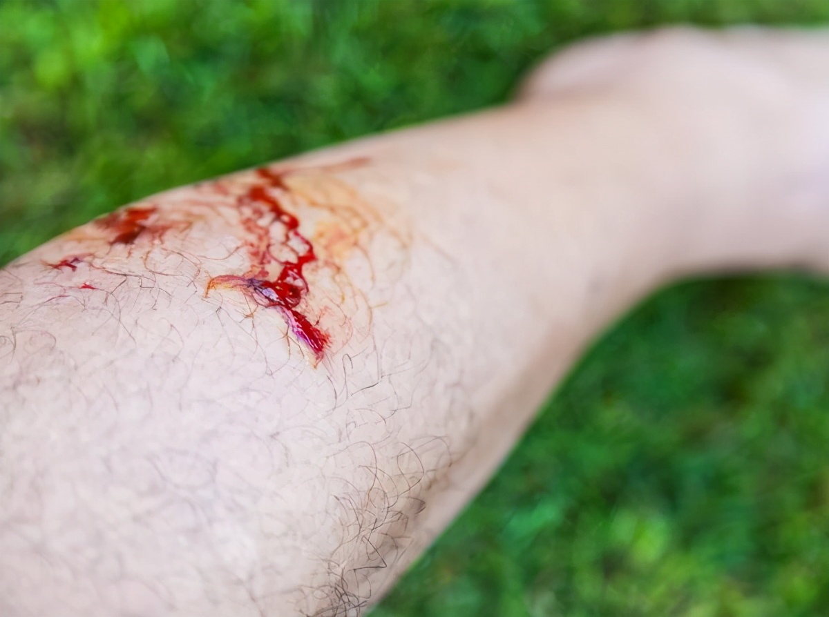 被狗咬伤,记住这三招,处理伤口!感染狂犬病后,有哪些表现?