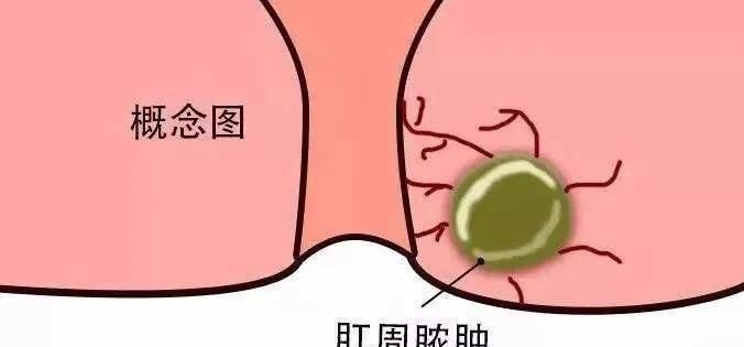 若初期不加以有效治疗和控制,肛周硬结逐渐增大,疼痛加重,中央变软继