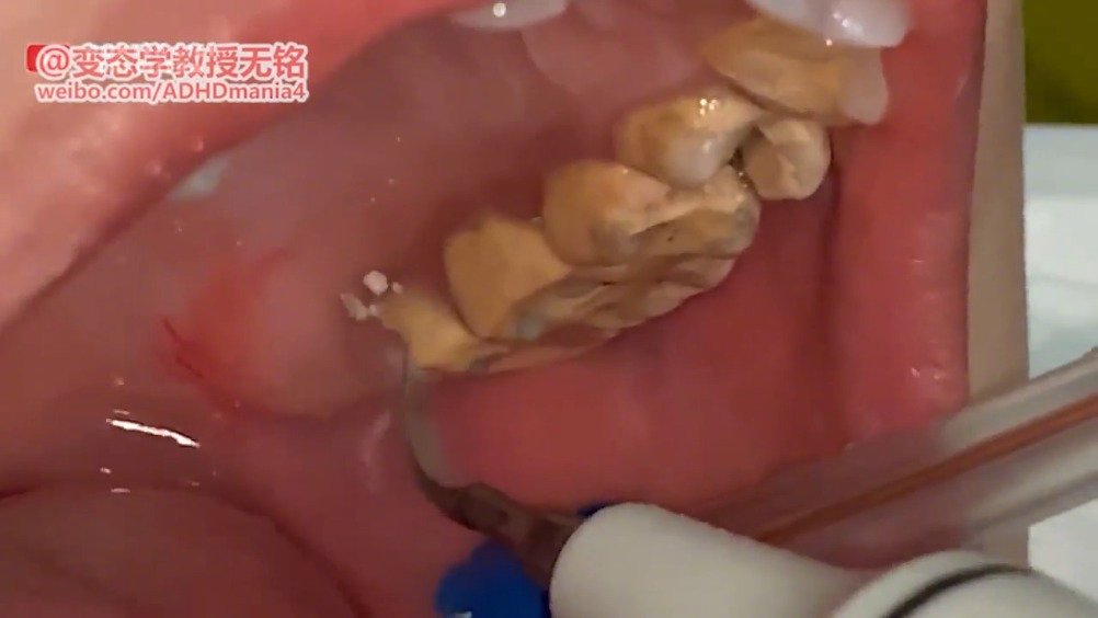 厚厚的牙结石,全部清除!
