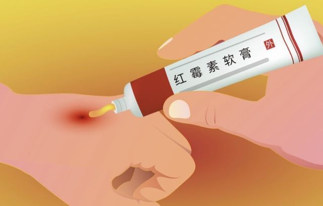 提醒！滥用红霉素软膏会培养出耐药性细菌 - Vimarsana News