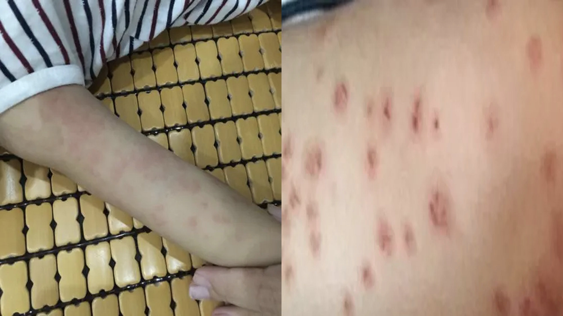 女子一觉醒来身上奇痒无比,爆出密密麻麻红疹子,近期多人中招!