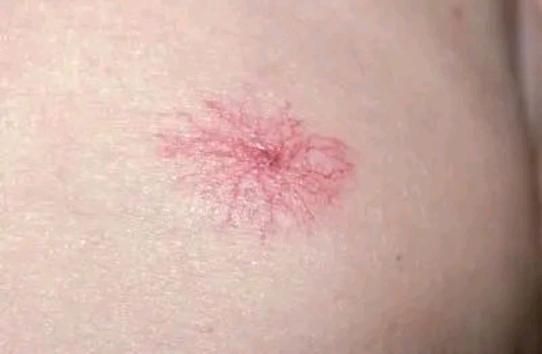 或许与这4个原因有关|肝脏|蜘蛛痣|胃部_新浪新闻