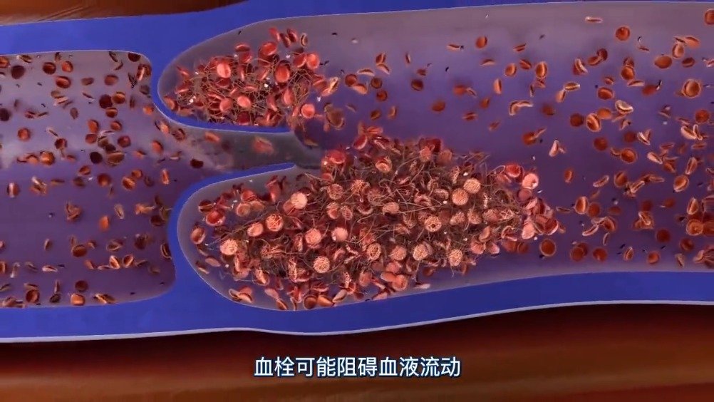 医学动画:深静脉血栓和肺栓塞_新浪新闻