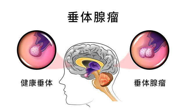 突发头痛视力下降眼肌麻痹等症状要警惕垂体卒中