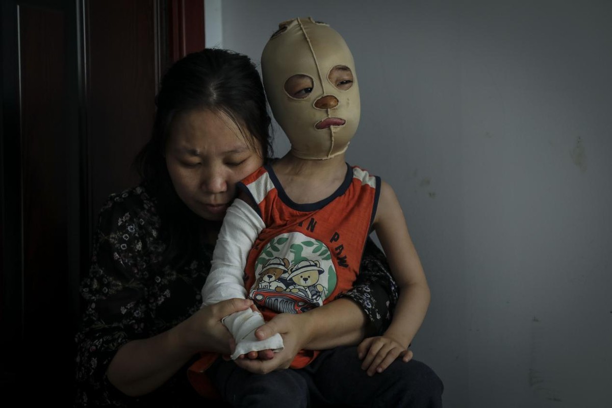 幼儿意外跌入开水盆严重烫伤如今成面具男孩母亲追悔莫及