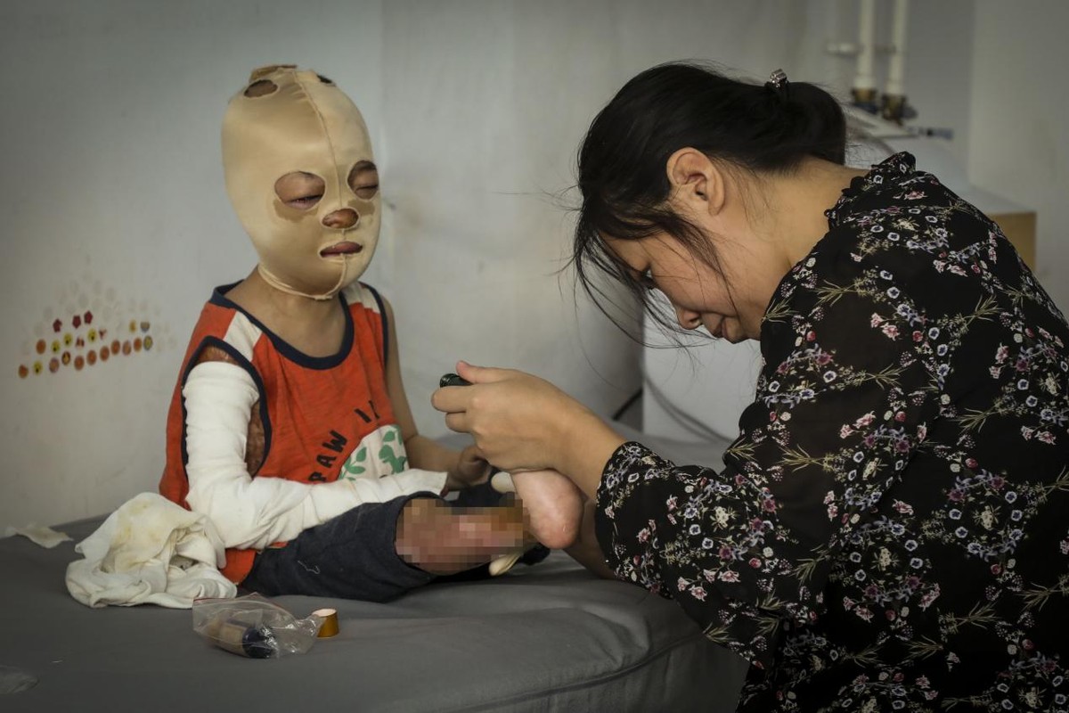 幼儿意外跌入开水盆严重烫伤如今成面具男孩母亲追悔莫及