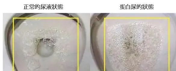 29岁小伙不痛不痒，查出尿毒症，排尿有5个变化，不能再拖休闲区蓝鸢梦想 - Www.slyday.coM