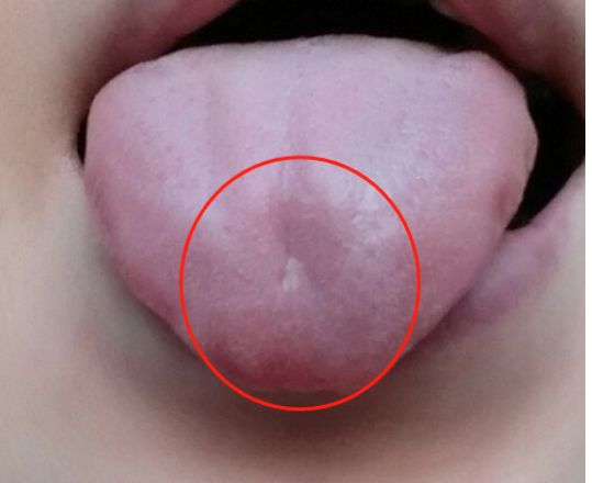 舌质淡,舌前凹陷,肺气不足.鼻炎时不时发作?