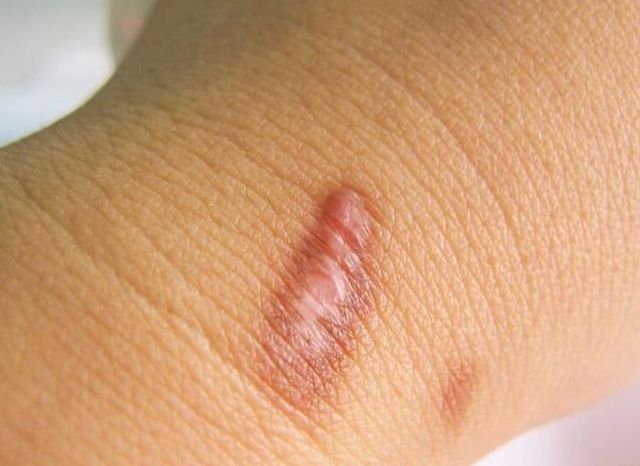 这么久了才知道原来这种才是疤痕体质