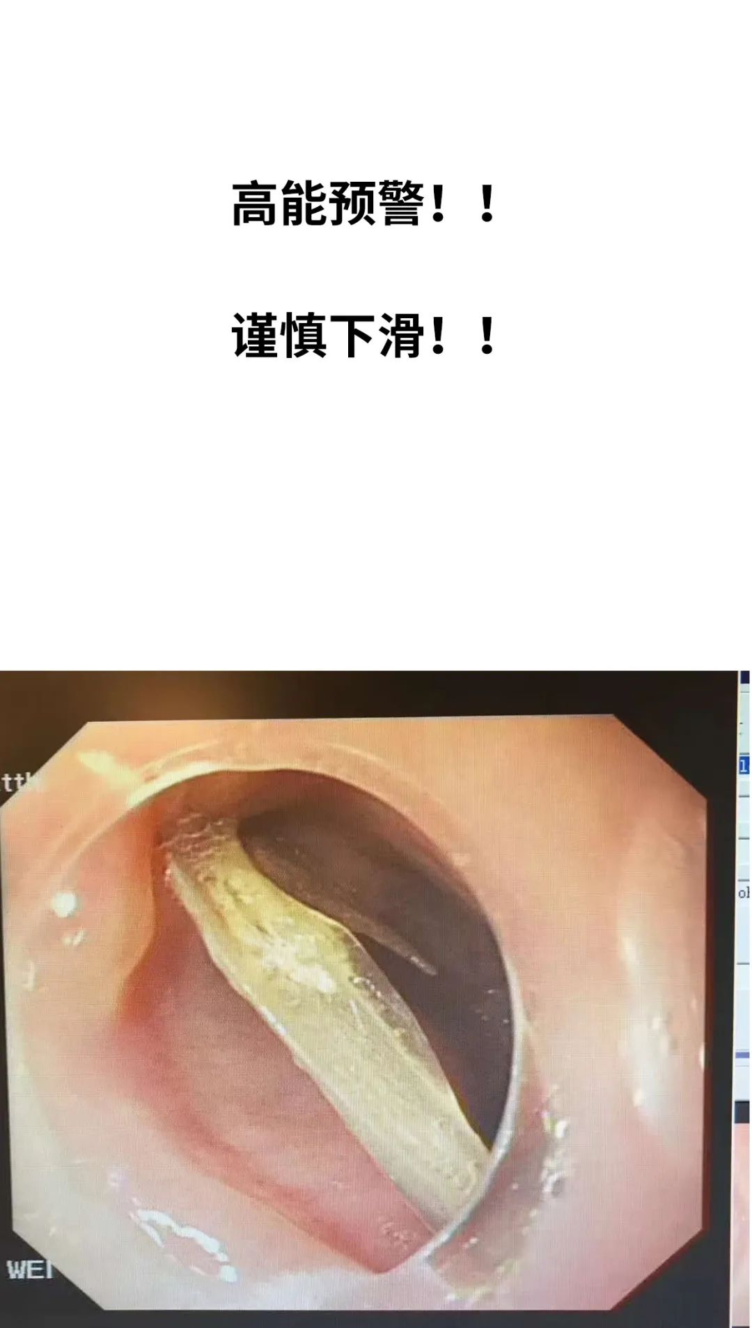 天呐,这东西是咋进到肚子里去的?|消化科医生笔记