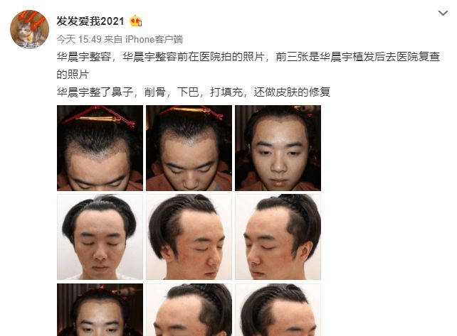 爆料华晨宇整容当事人道歉,自称图源朋友,恳请花花放过休闲区蓝鸢梦想 - Www.slyday.coM 爆料华晨宇整容当事人道歉,自称图源朋友,恳请花花放过休闲区蓝鸢梦想 - Www.slyday.coM