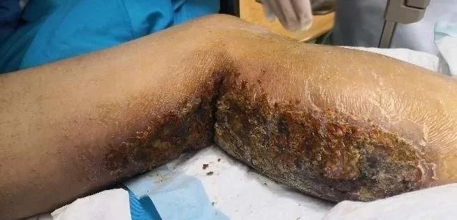 年轻小伙吃下5片安眠药一觉醒来身上出现大片瘀斑