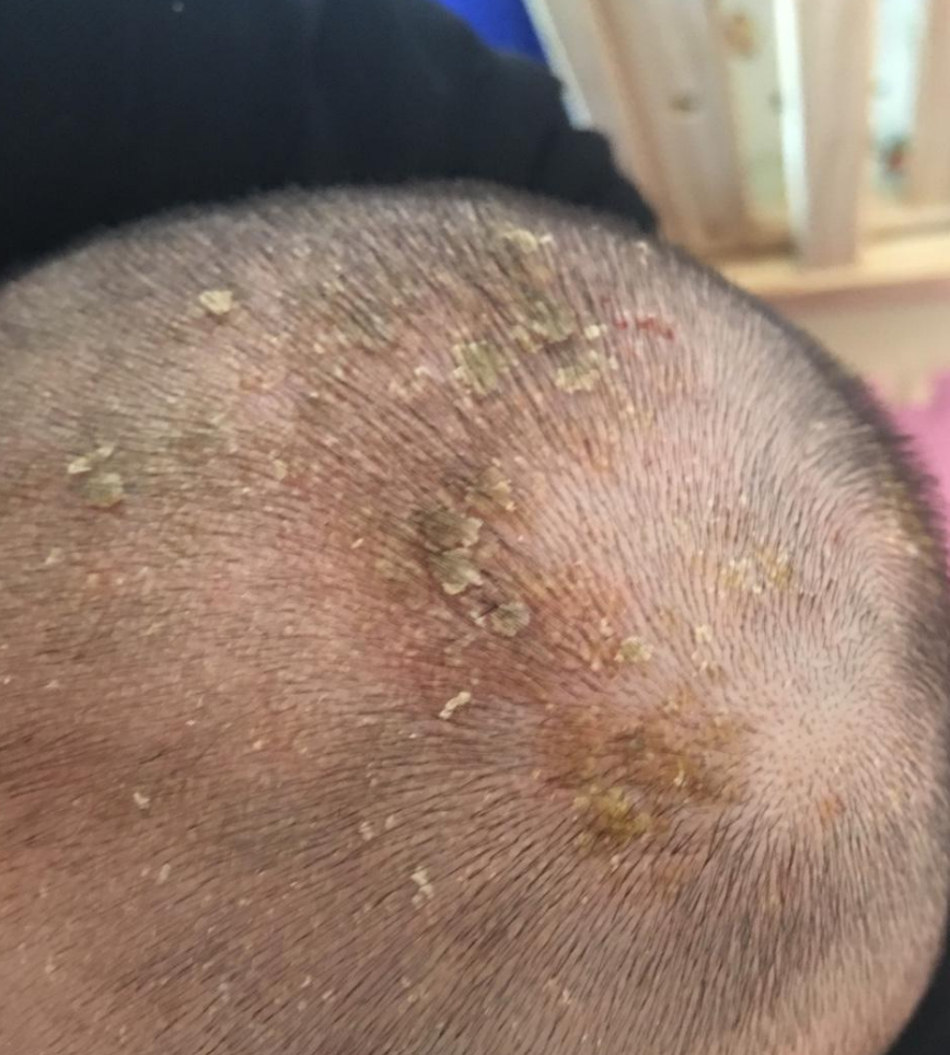 有种"无知"叫抠新生儿乳痂,乳痂是清干净了,却把