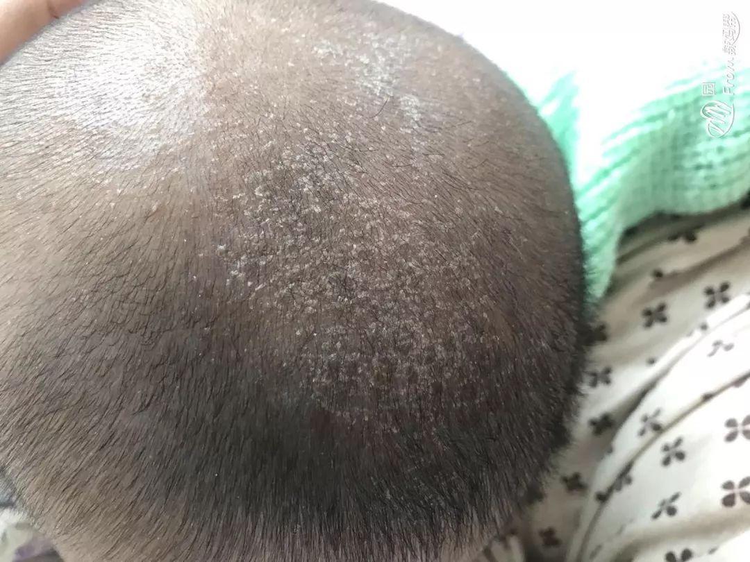 有种无知叫抠新生儿乳痂乳痂是清干净了却把孩子送进医院