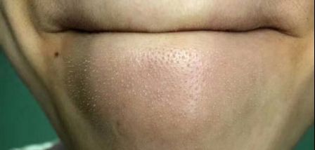 鸡皮肤一热脸发红(鸡脸变红怎么回事怎么办) 鸡皮肤一热脸发红(鸡脸变红怎么回事怎么办)