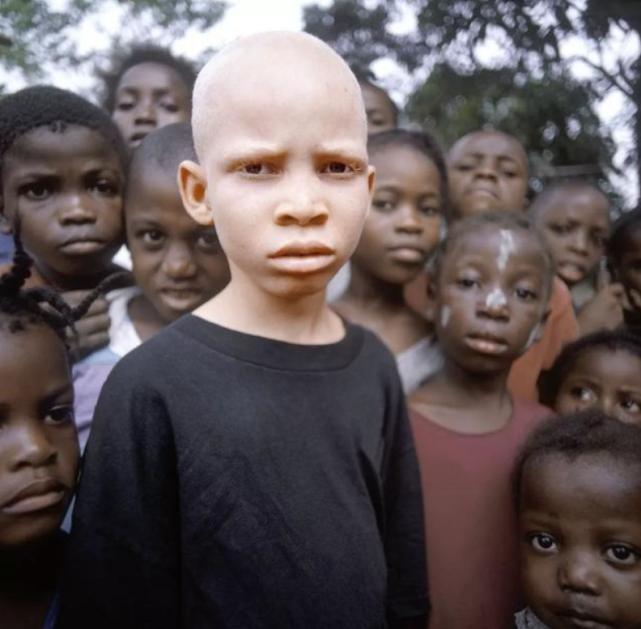 血液比黄金还贵,警察24小时贴身护卫|坦桑尼亚|黑人|白化病_新浪新闻