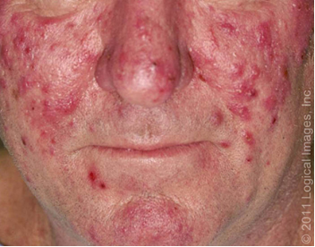 脸上总是又红又热原来是玫瑰痤疮惹的祸