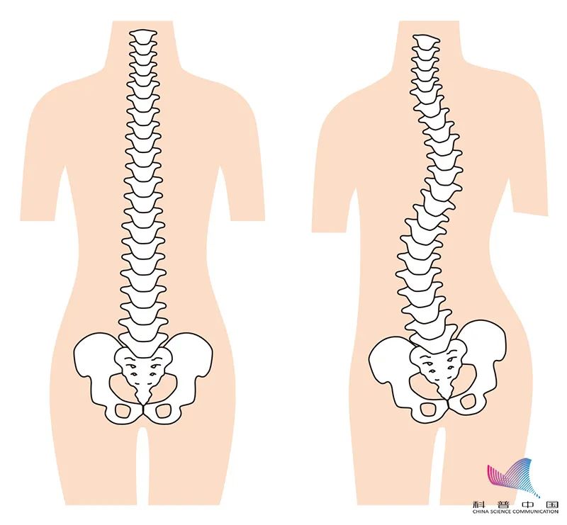 一男子脊柱拧成"麻花",竟是因为跷二郎腿!很多人还在做