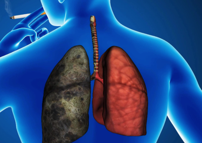 肺癌并非"悄无声息",头和手出现4种异常,尽早查肺ct,别再拖