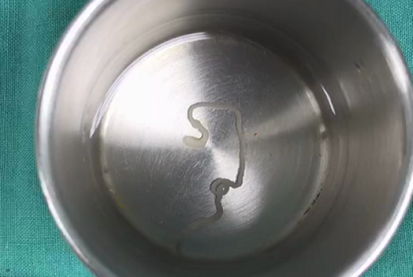 男子大脑内取出10厘米长活虫 曾信土方生吃青蛙导致癫痫_新浪新闻