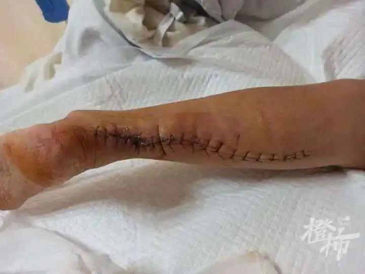 高温天“毛孩子”突然“翻脸”，有女子被自家宠物咬伤险截肢休闲区蓝鸢梦想 - Www.slyday.coM