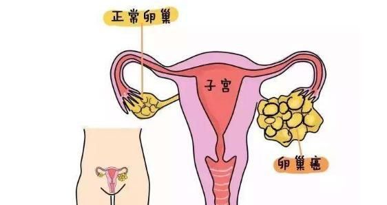 卵巢癌让人们闻之色变那么卵巢癌在发生的前期有什么症状