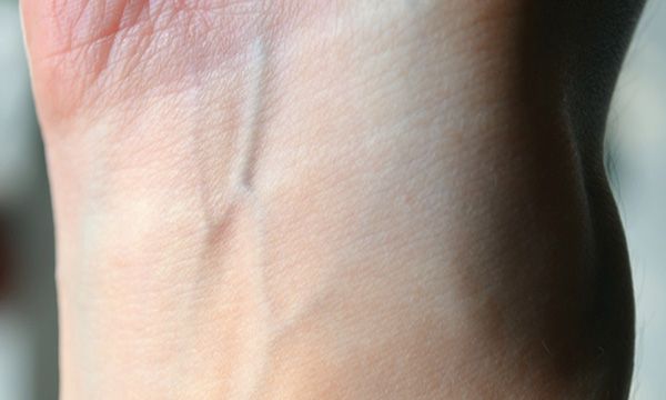 抽血、输液后,扎针处为何会出现一片淤青?不妨了解下,涨涨知识休闲区蓝鸢梦想 - Www.slyday.coM 抽血、输液后,扎针处为何会出现一片淤青?不妨了解下,涨涨知识休闲区蓝鸢梦想 - Www.slyday.coM