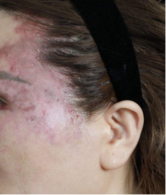 接受了眼眶部位的自体脂肪填充,结果眼周的皮肤变色坏死,视力也越来越