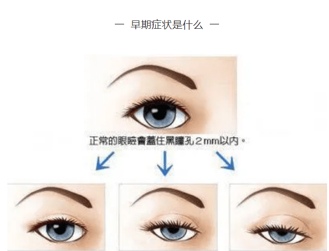 重症肌无力|眼肌|症状_新浪新闻