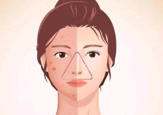 当面部发生炎症时,挤压可使脓液和静脉内含细菌的栓子进入颅内海绵窦