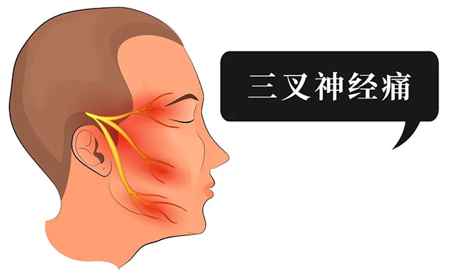 男子额部电击般剧痛骤发骤停一查竟是患上三叉神经痛