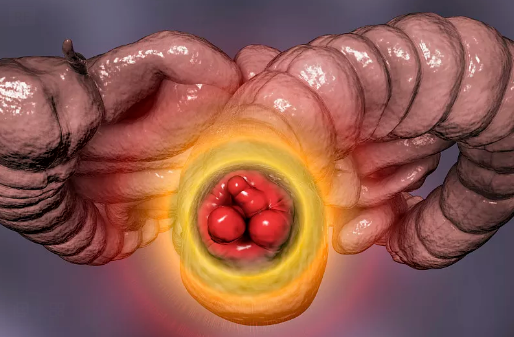 医生:重视这项检查|痔疮|直肠癌_新浪新闻