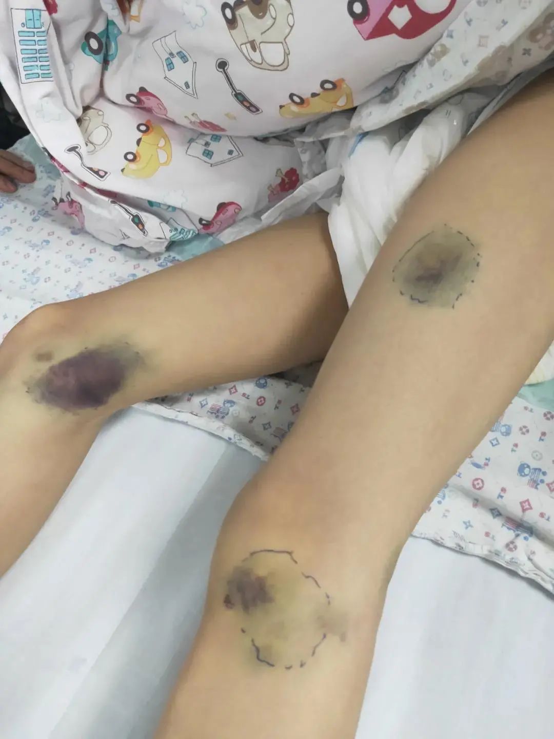 广西9岁男孩凝血功能极度异常被送进icu事后他吐露实情