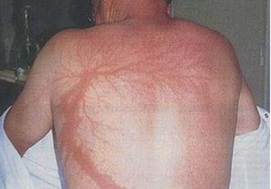 3人自拍遭雷击事发时在树下避雨引雷的是手机还是大树