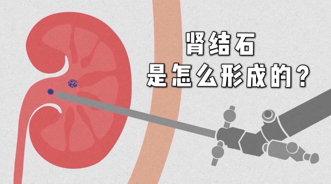 南宁能体外碎石的医院 南宁哪些医院治疗肾结石好