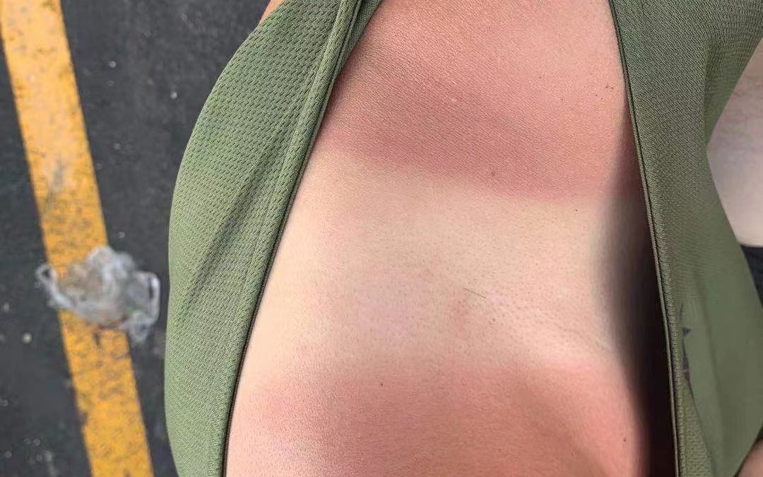 24日,关宏予发的晒黑图.受访者供图