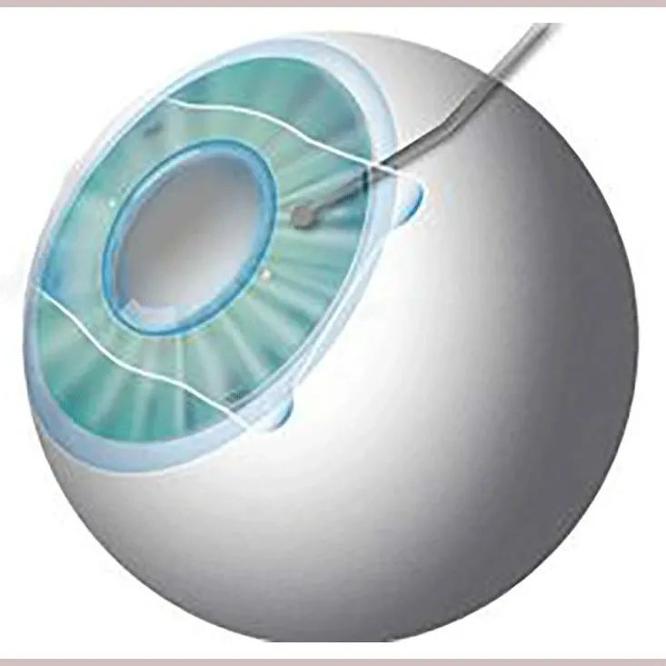 近视手术0套路 重磅福利来袭|手术|晶体|角膜_新浪新闻