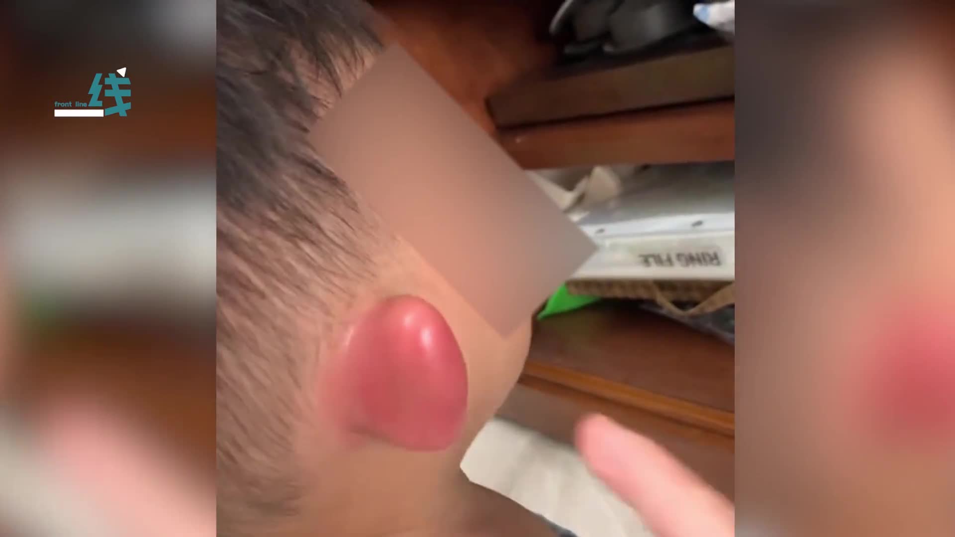 孩子耳朵被蚊子咬变"大耳朵图图" 妈妈忍不住"玩"起孩子耳朵