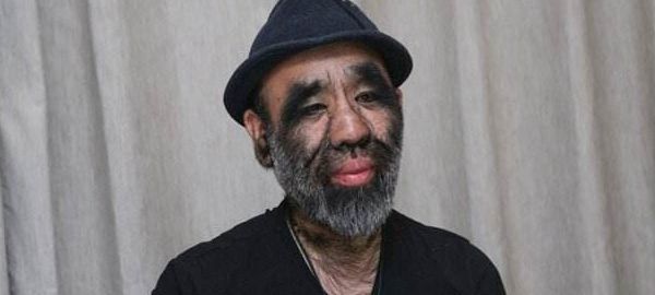 浑身长满长毛被誉为小野人43年过去他的现状怎么样了