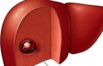 肝血管瘤早期的4大症状 早发现,早治疗很关键