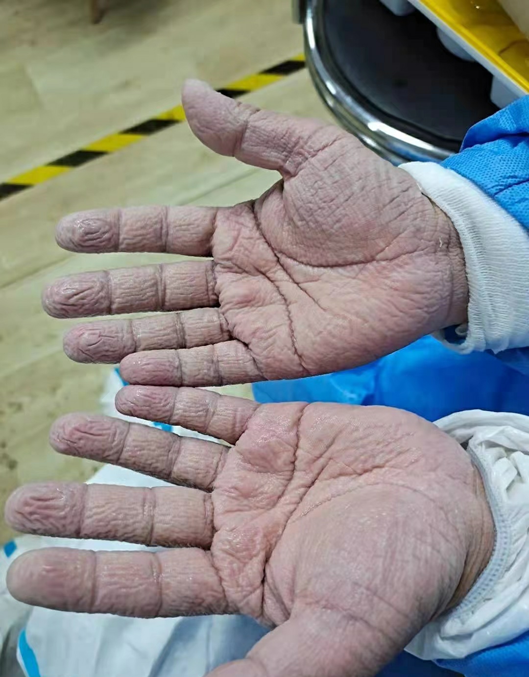 其中一张照片显示,医护人员摘下手套的双手已经满是褶皱